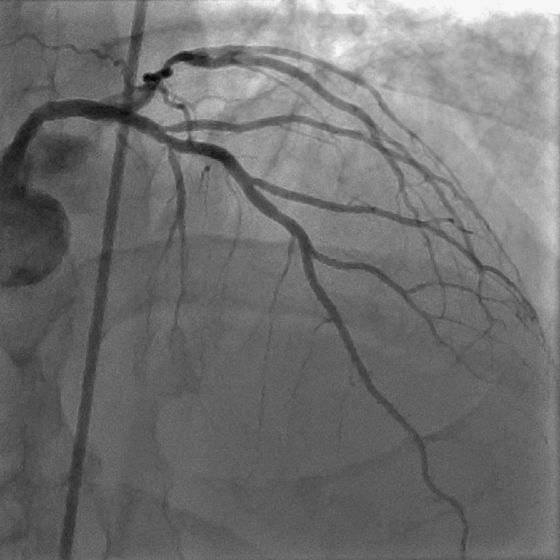 Cardiology Coronarographie