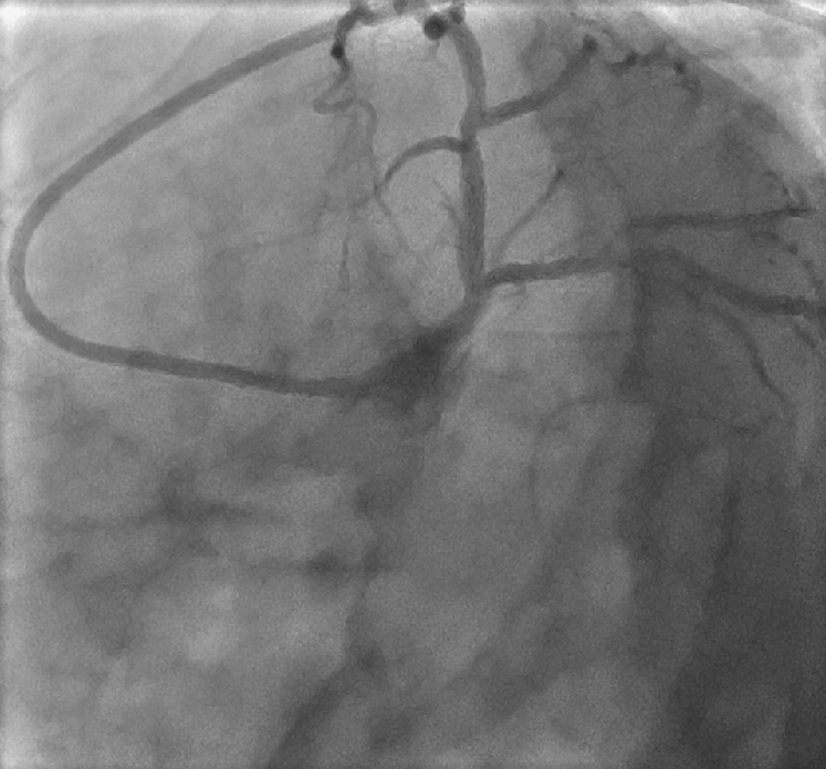 Cardiology Coronarographie