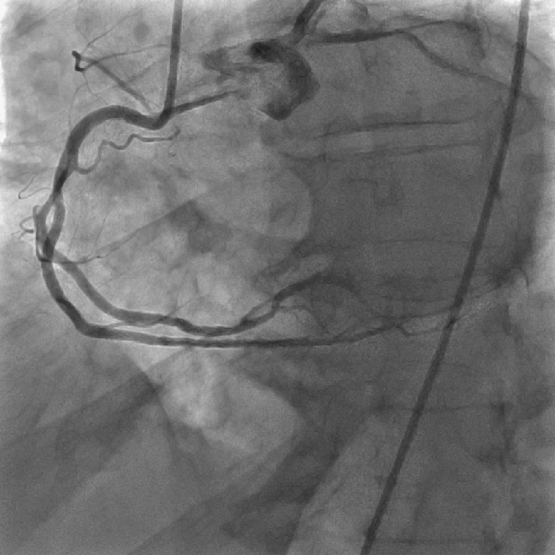 Cardiology Coronarographie