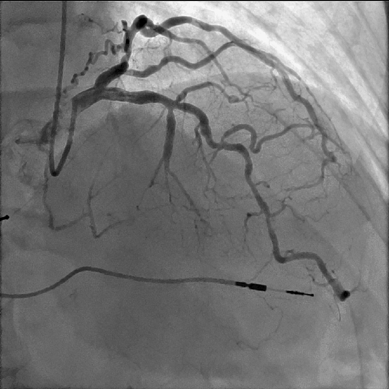 Cardiology Coronarographie