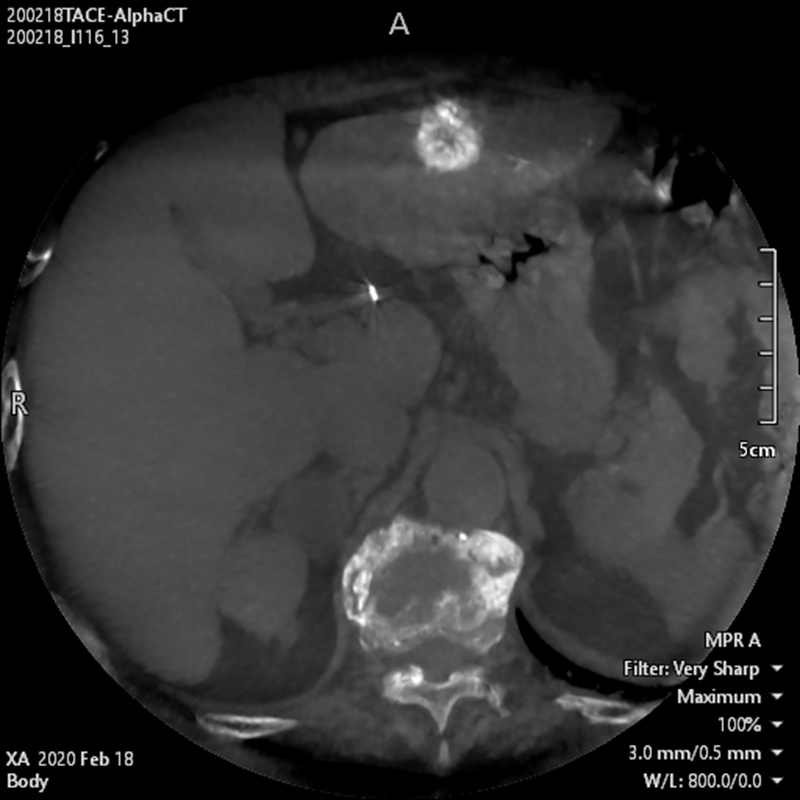 Interventional Radiology TDM « Alpha » abdominale