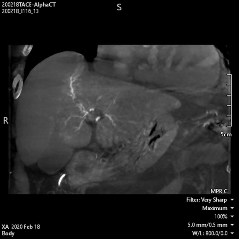 Interventional Radiology TDM « Alpha » abdominale