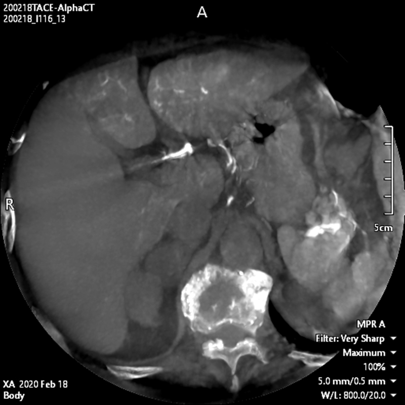 Interventional Radiology TDM « Alpha » abdominale