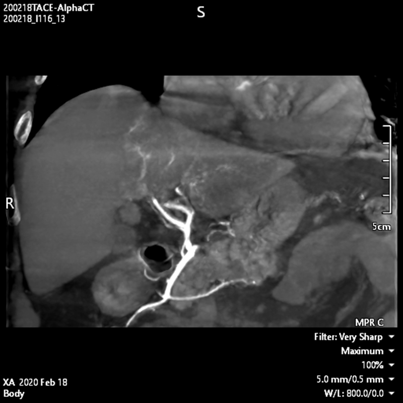 Interventional Radiology TDM « Alpha » abdominale