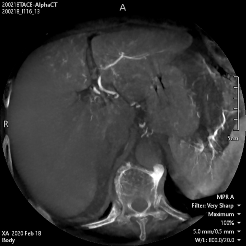 Interventional Radiology TDM « Alpha » abdominale