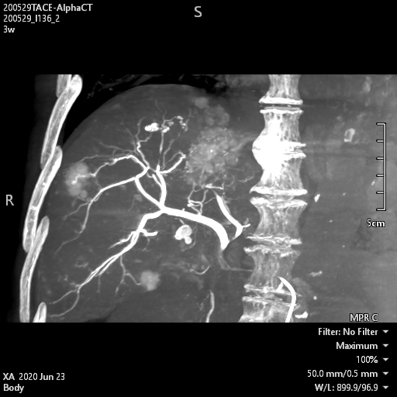 Interventional Radiology TDM « Alpha » abdominale