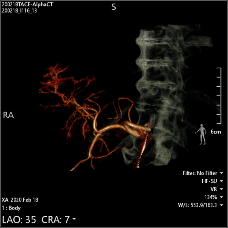 Interventional Radiology TDM « Alpha » abdominale