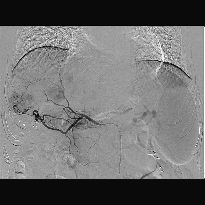 Interventional Radiology Angiographie par soustraction numérique