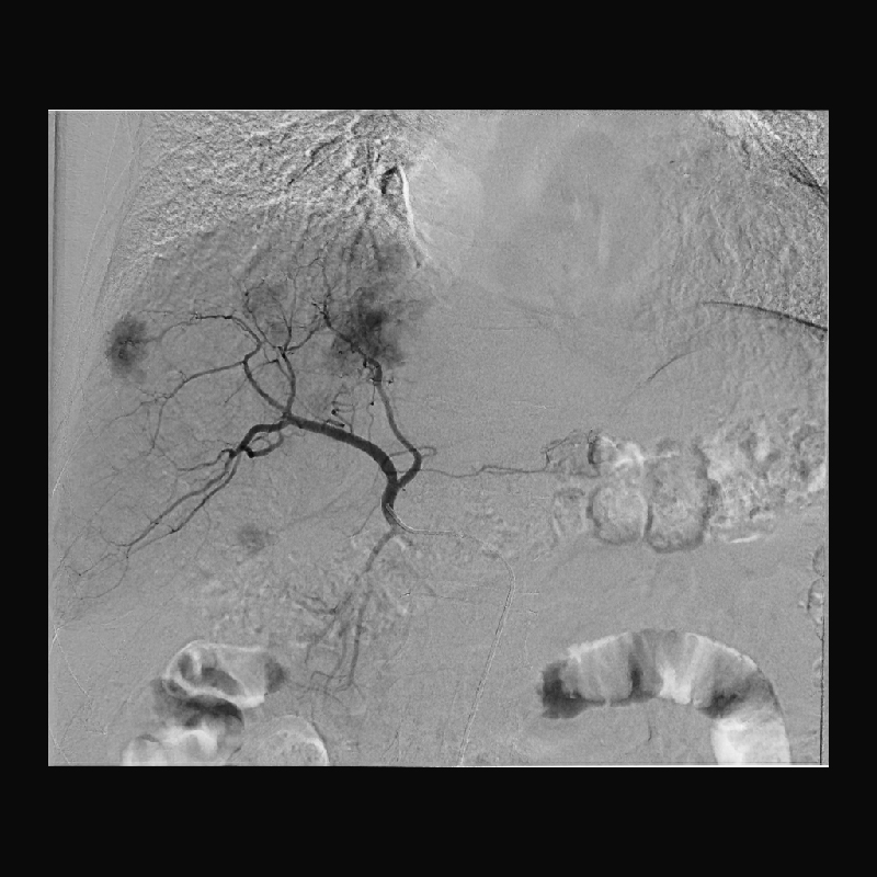 Interventional Radiology Angiographie par soustraction numérique