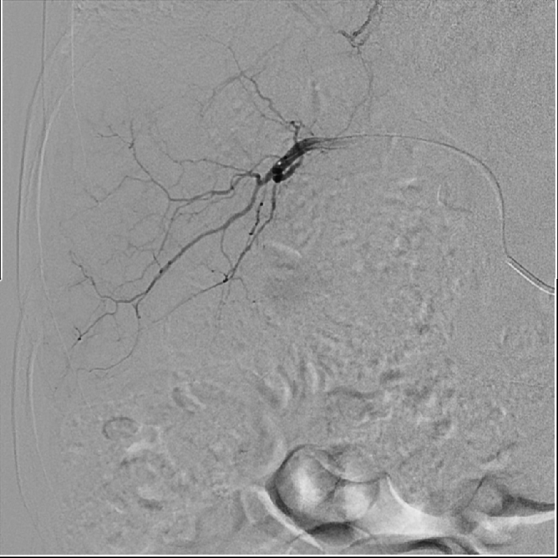 Interventional Radiology Angiographie par soustraction numérique
