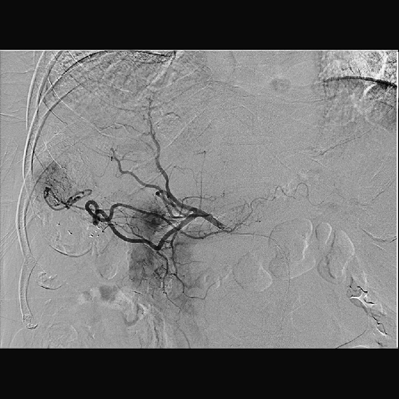 Interventional Radiology Angiographie par soustraction numérique