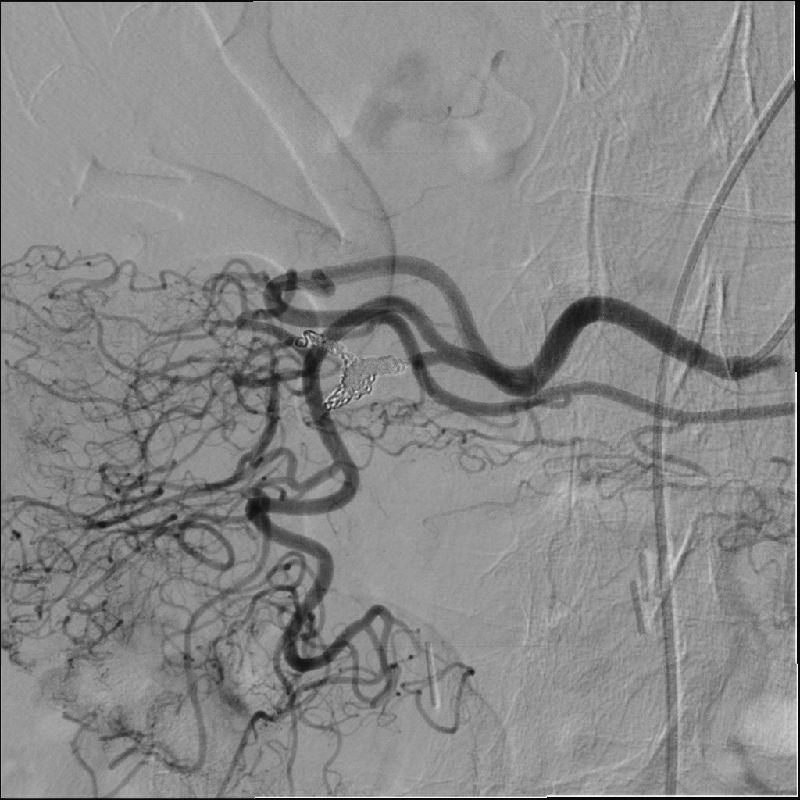 Interventional Radiology Angiographie par soustraction numérique