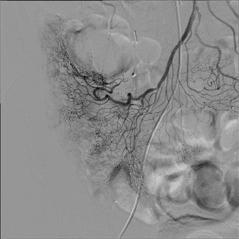 Interventional Radiology Angiographie par soustraction numérique
