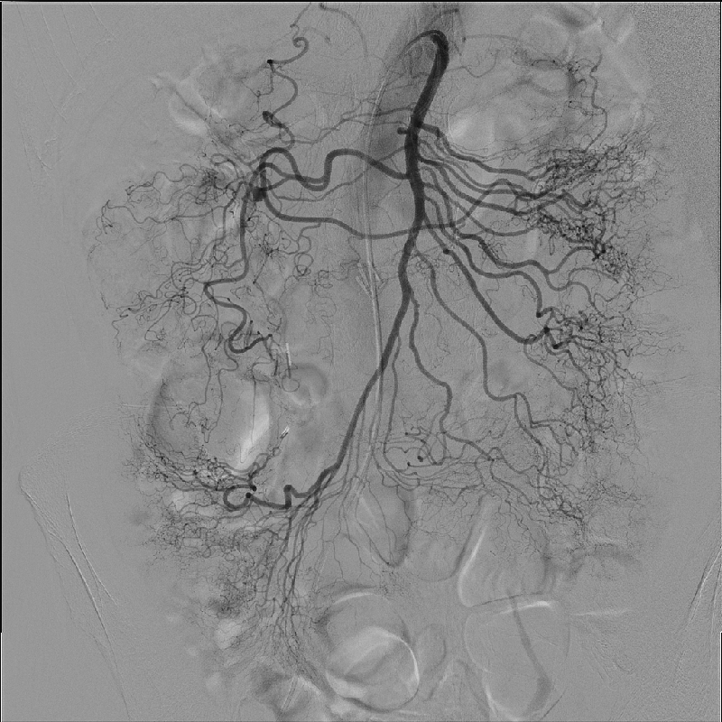 Interventional Radiology Angiographie par soustraction numérique