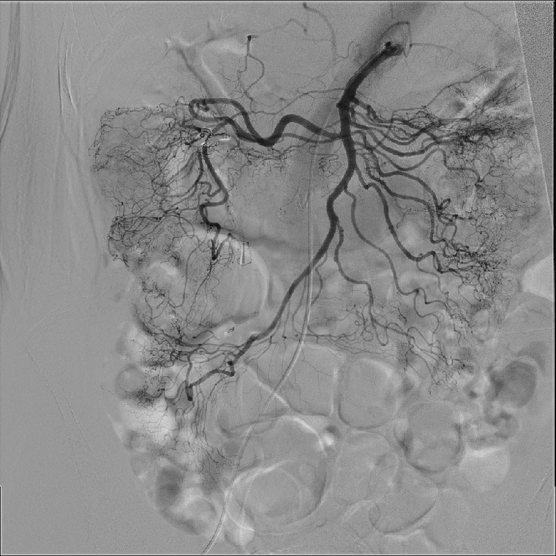 Interventional Radiology Angiographie par soustraction numérique