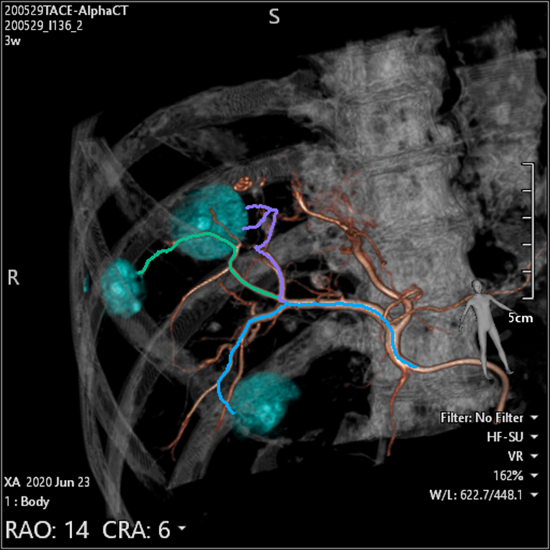 Interventional Radiology Plan d’embolisation