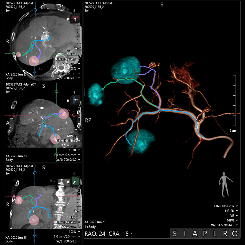 Interventional Radiology Plan d’embolisation