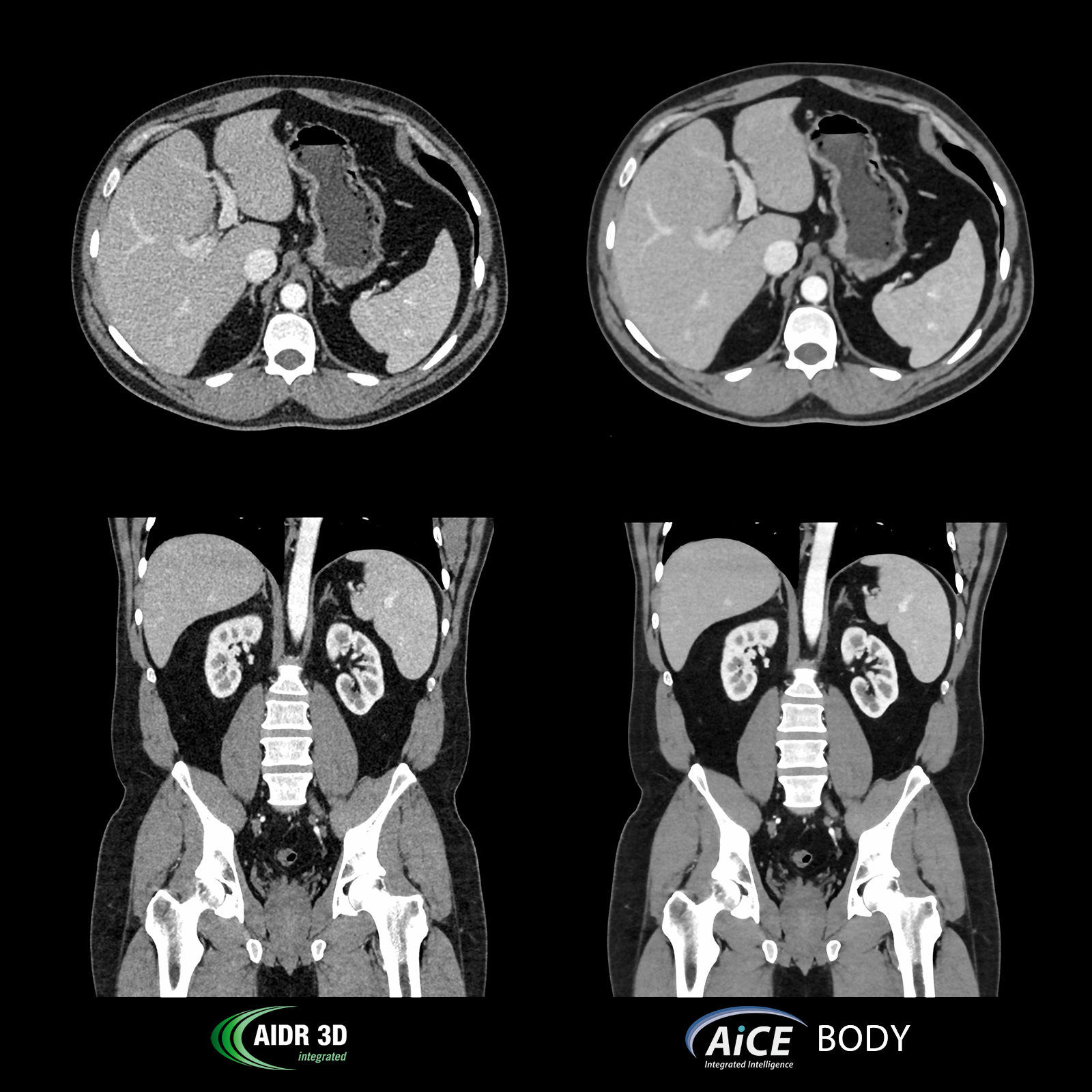 Aquilion Prime SP Abdomen, pelvis, AiCE