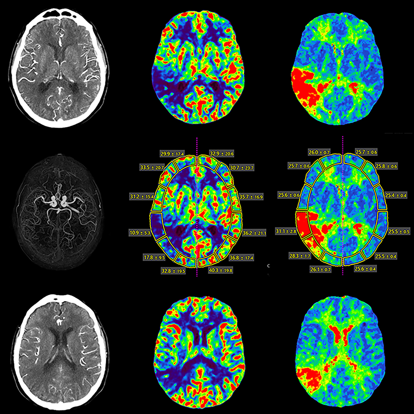 Aquilion ONE / PRISM Edition Perfusion cérébrale, occlusion du côté droit, TDM volumique, AiCE