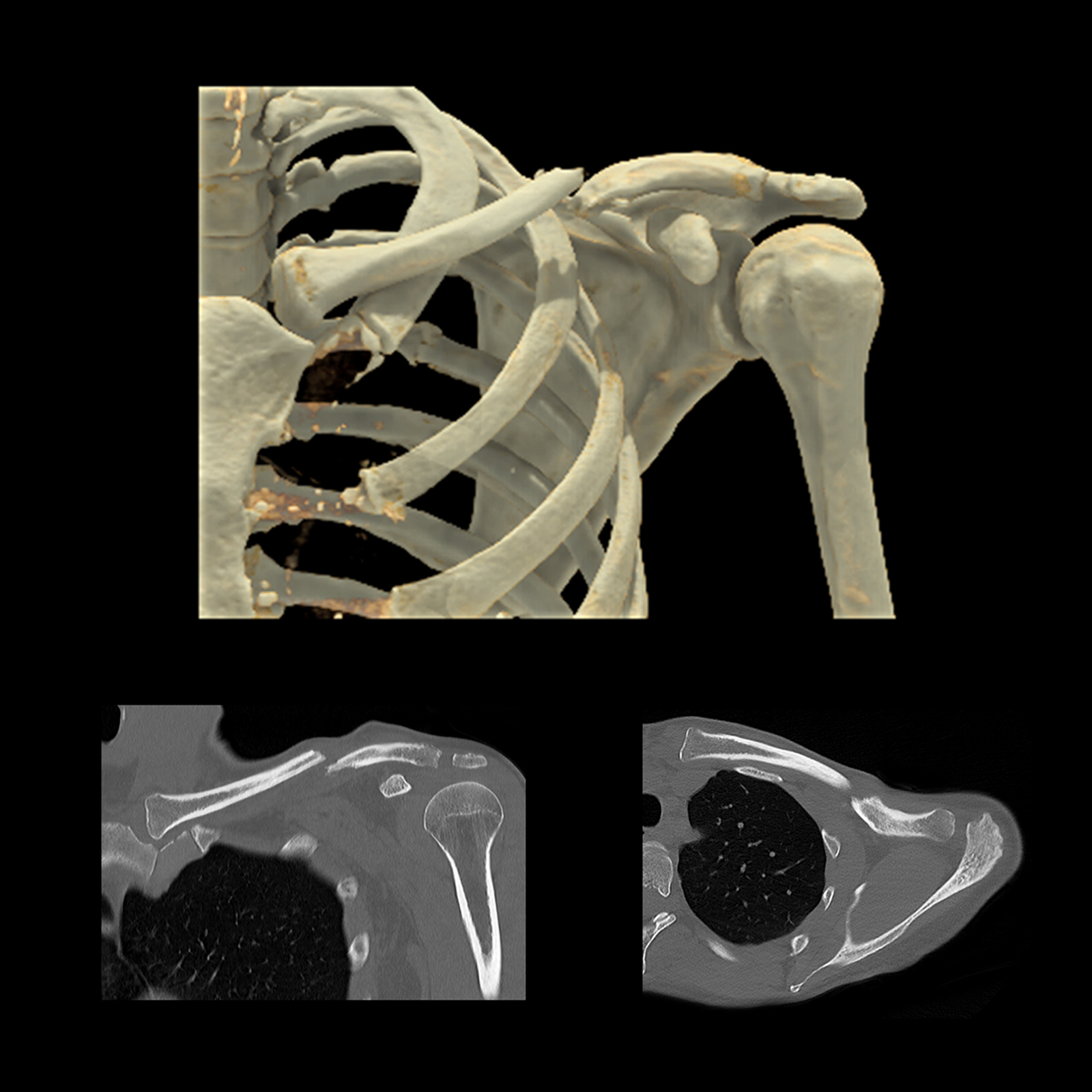 Aquilion ONE / GENESIS Edition Fracture désunie de la clavicule, AiCE