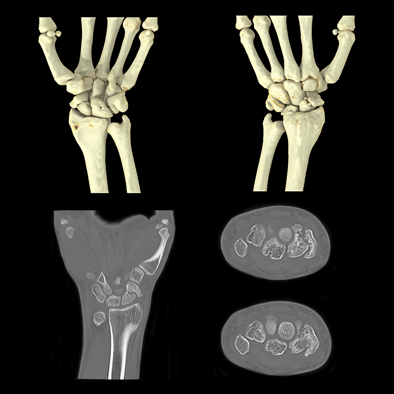 Aquilion ONE / GENESIS Edition Fracture du scaphoïde du poignet, AiCE