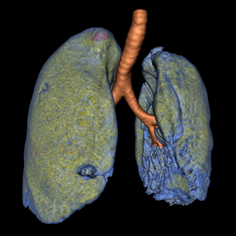 Ultra Low Dose Chest
