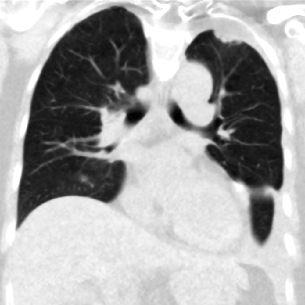 Ultra Low Dose Chest