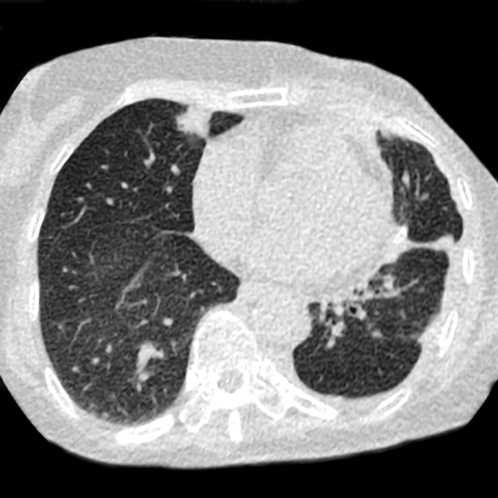 Ultra Low Dose Chest