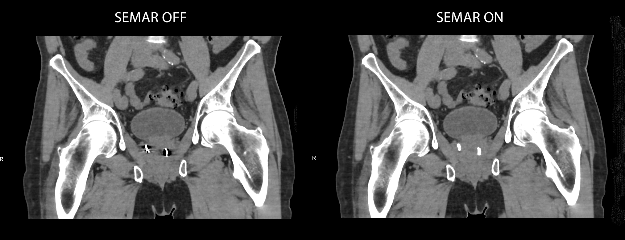 Aquilion Exceed LB Prostate avec implants de curiethérapie