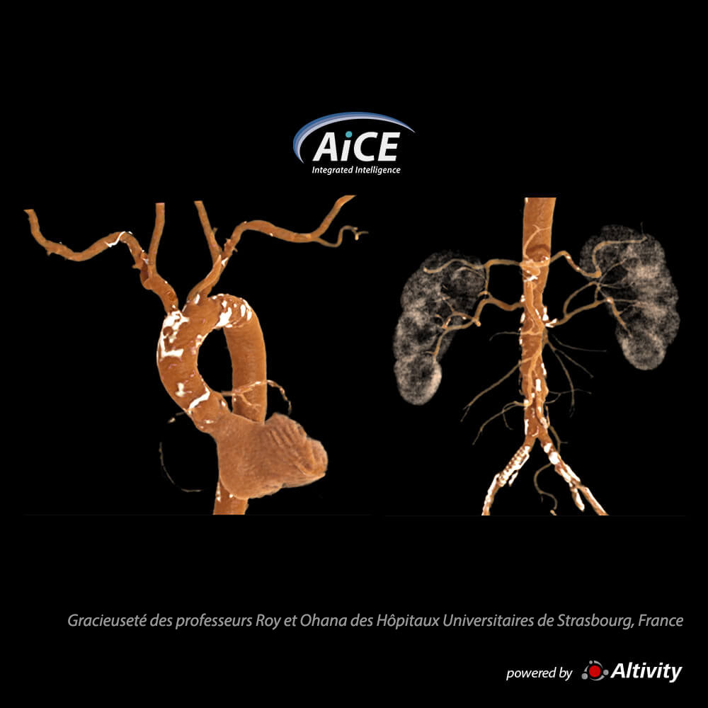 Aquilion ONE / INSIGHT Edition Angio-TDM de l'aorte 1