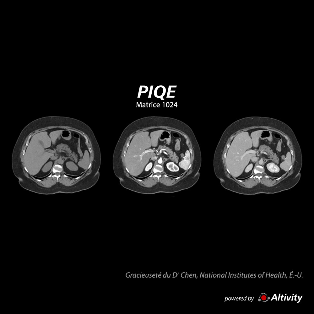 Aquilion ONE / INSIGHT Edition Abdomen multiphase IMC 40