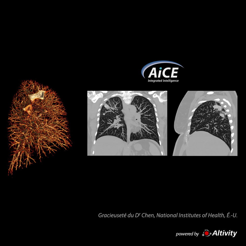 Aquilion ONE / INSIGHT Edition Infection pulmonaire à Cryptococcus