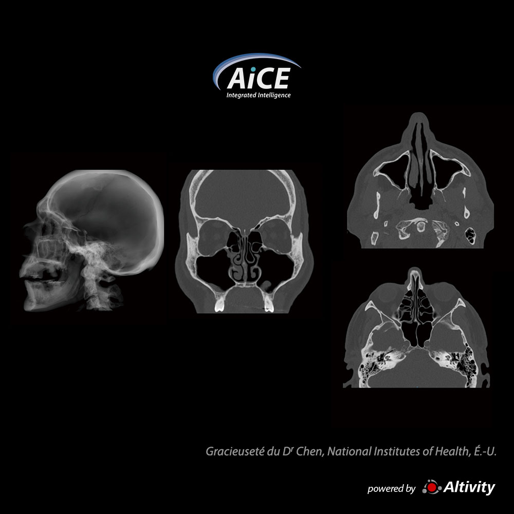 Aquilion ONE / INSIGHT Edition Sinus