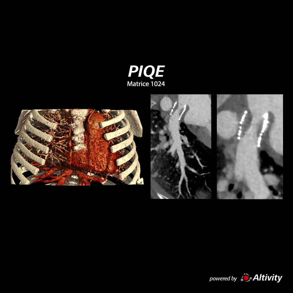 Aquilion ONE / INSIGHT Edition Patient cardiaque âgé de 2 ans