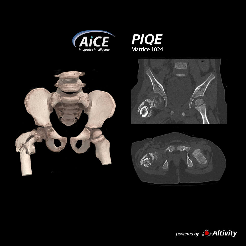 Aquilion ONE / INSIGHT Edition Fracture pelvienne