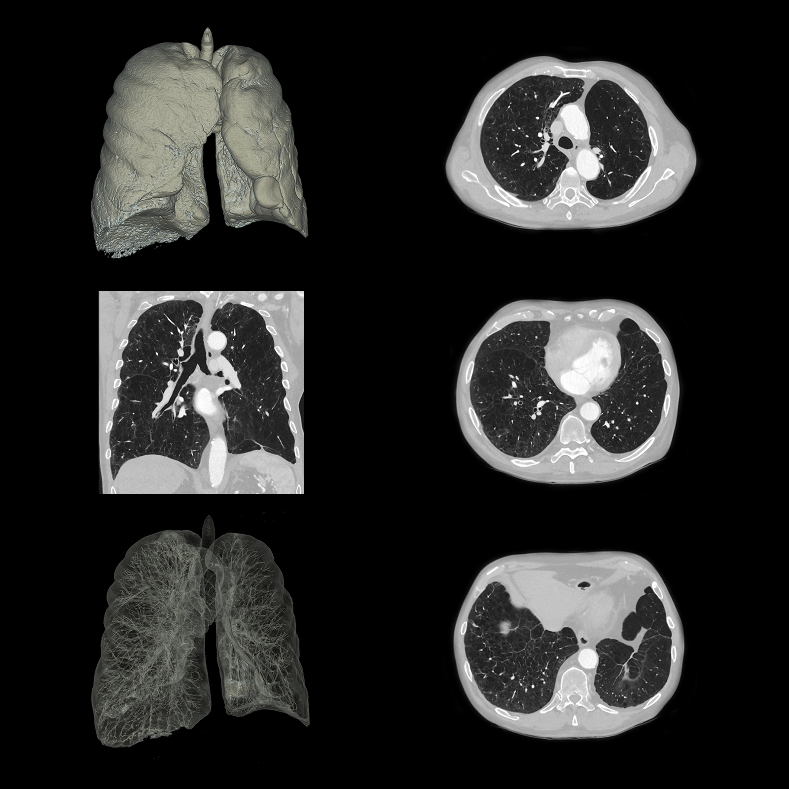 Aquilion ONE / PRISM Edition Emphysème pulmonaire, AiCE