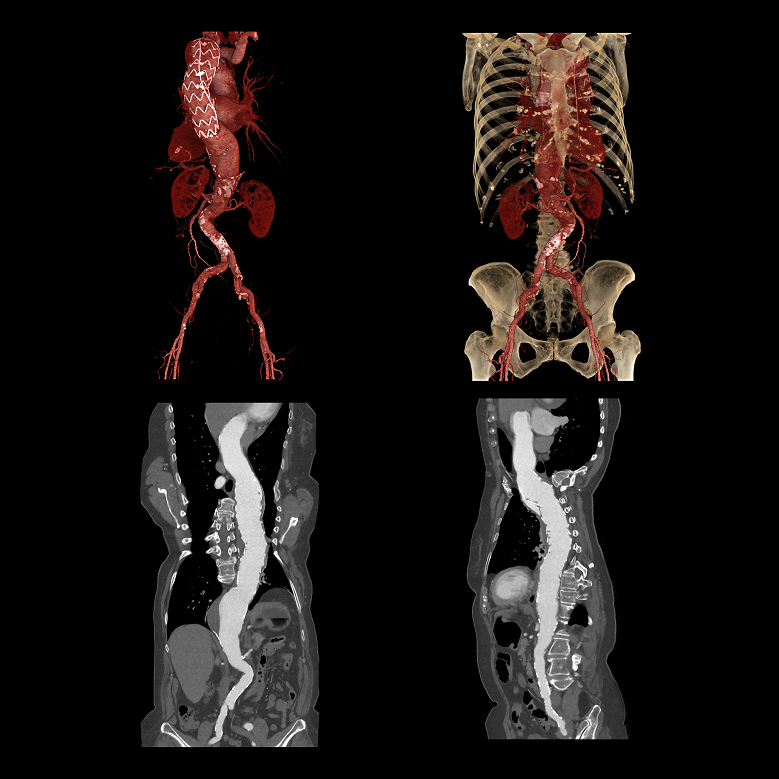 Aquilion ONE / PRISM Edition Suivi d’une endoprothèse de l’aorte thoracique, AiCE