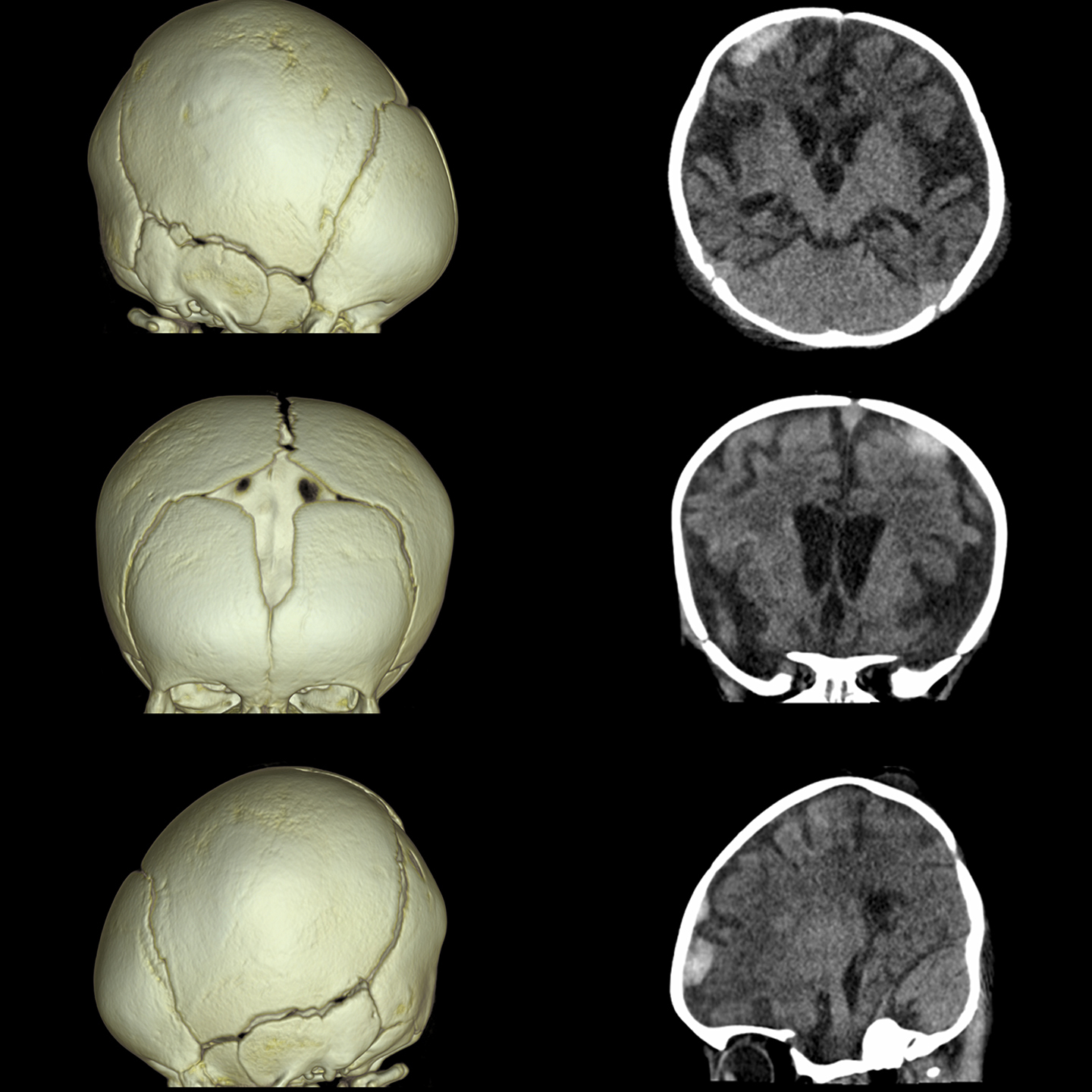 Aquilion ONE / PRISM Edition Hématome sous-dural du cerveau, TDM volumique*