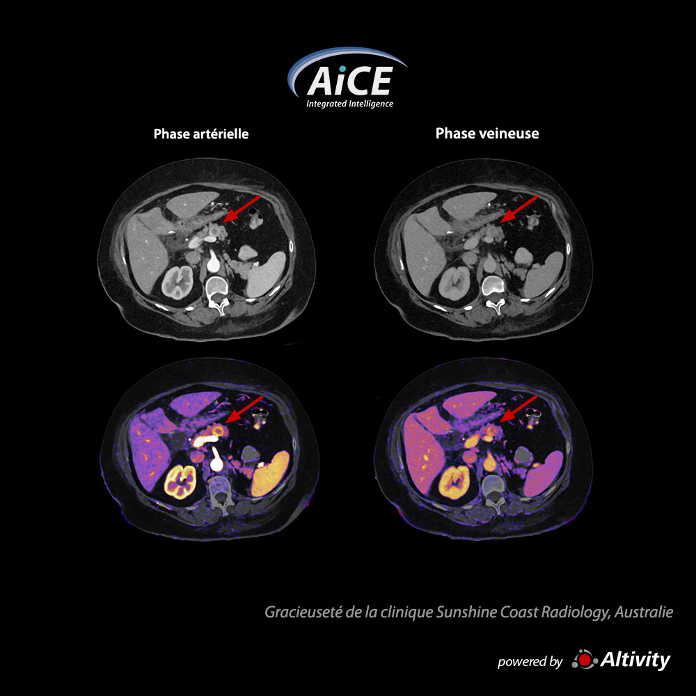 Body Abdomen avec cartographie à l’iode