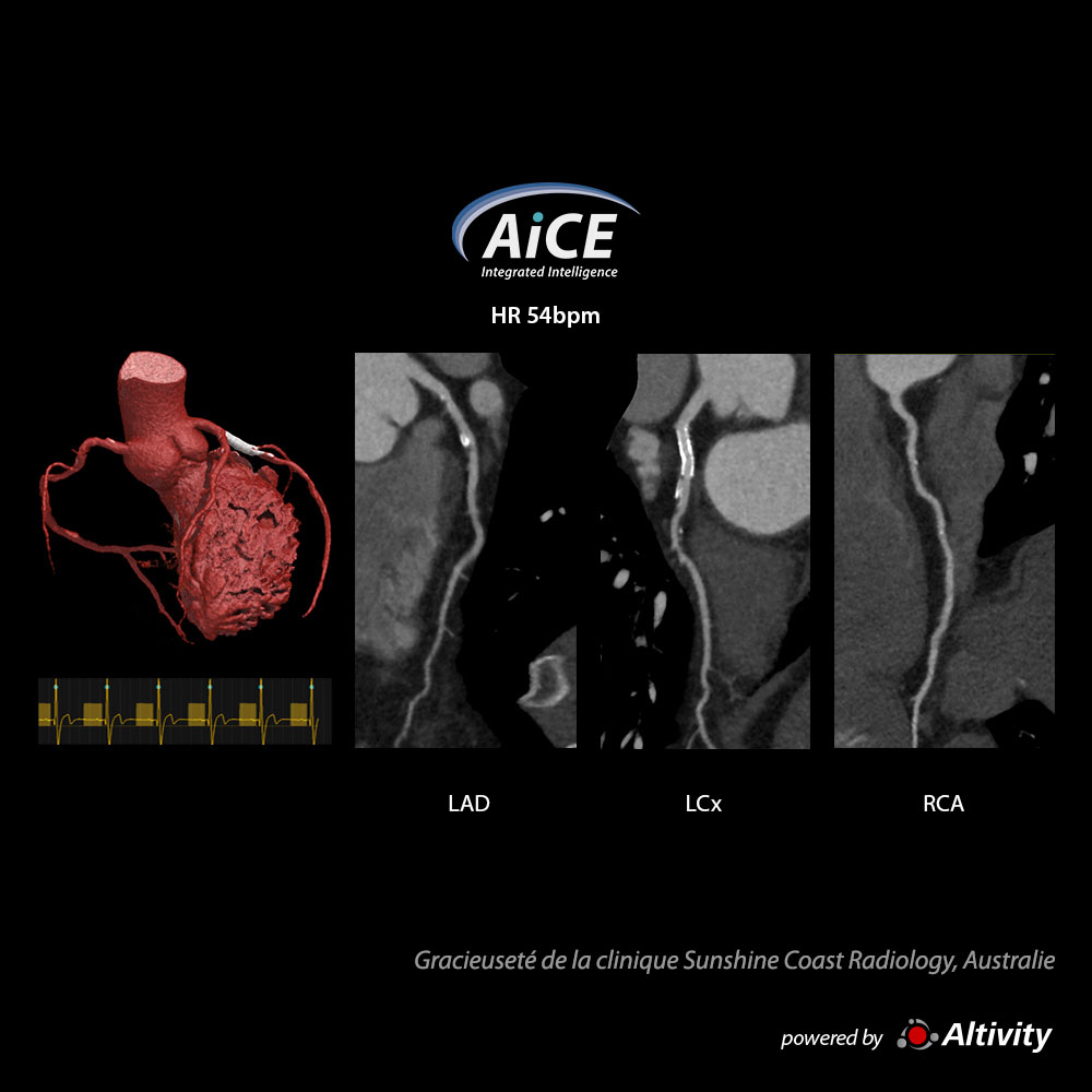 Cardiac Cardiaque – Endoprothèse