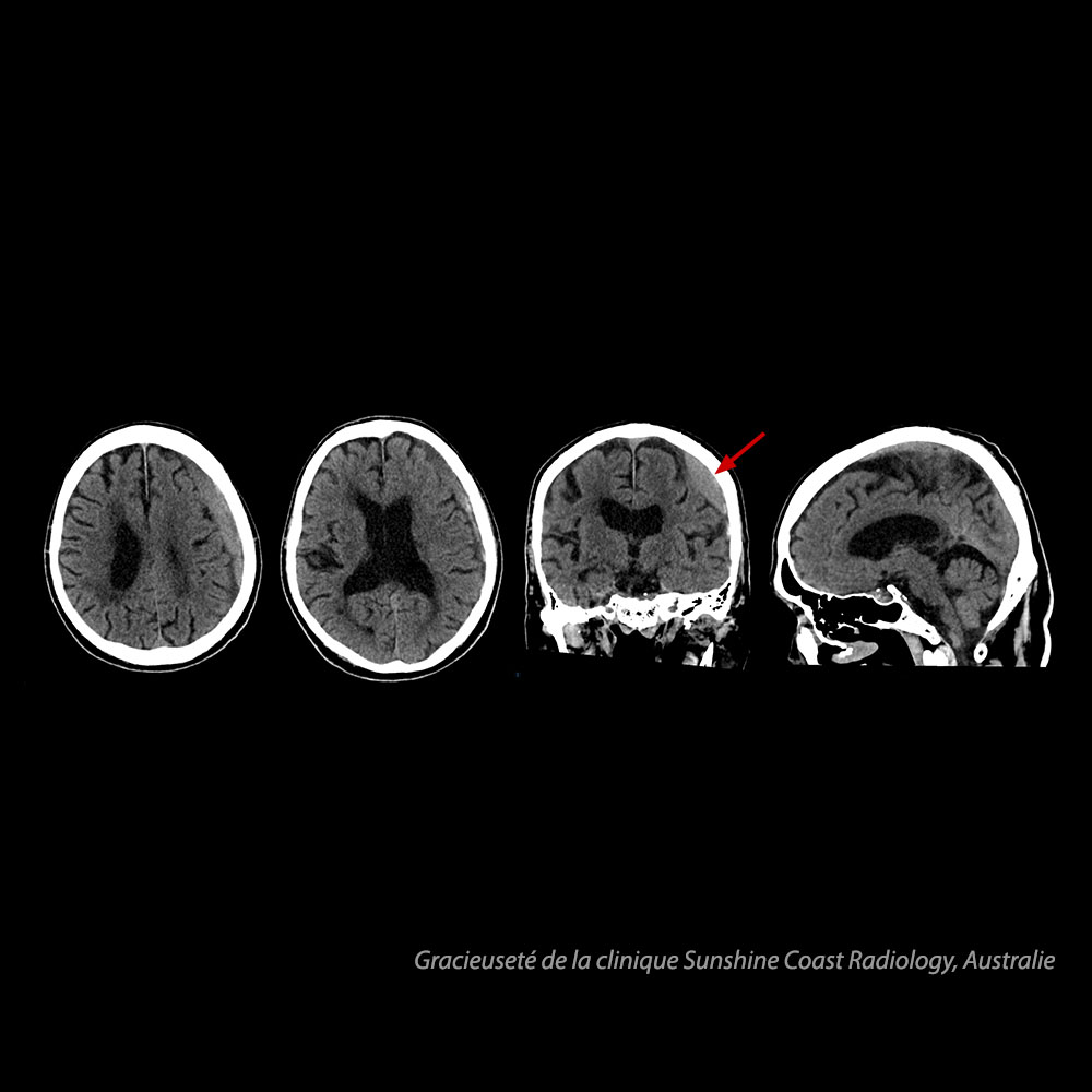 Headneck Cerveau – Hématome sous-dural
