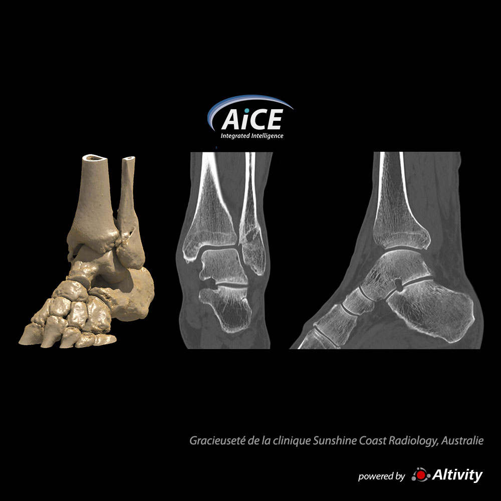 Msk Fracture à la cheville