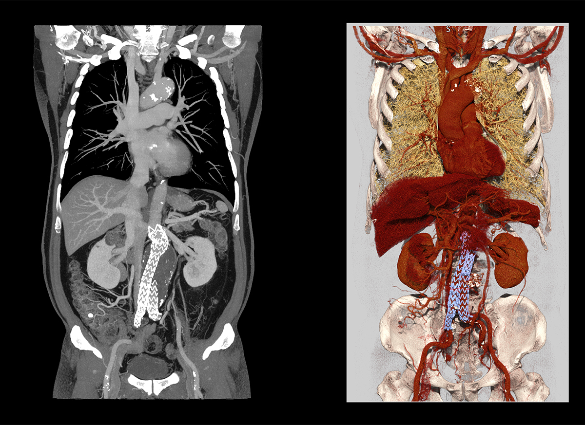 Body Anévrisme de l'aorte abdominale et endoprothèse