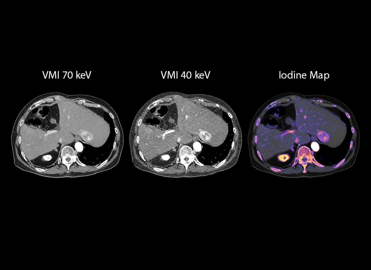 Liver Tumor