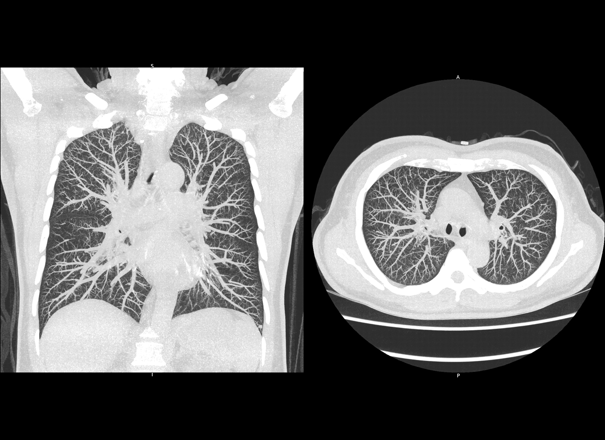 Chest Dépistage pulmonaire à faible dose
