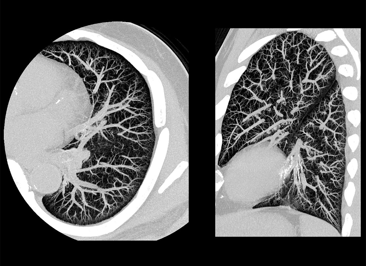 Chest Thorax 1