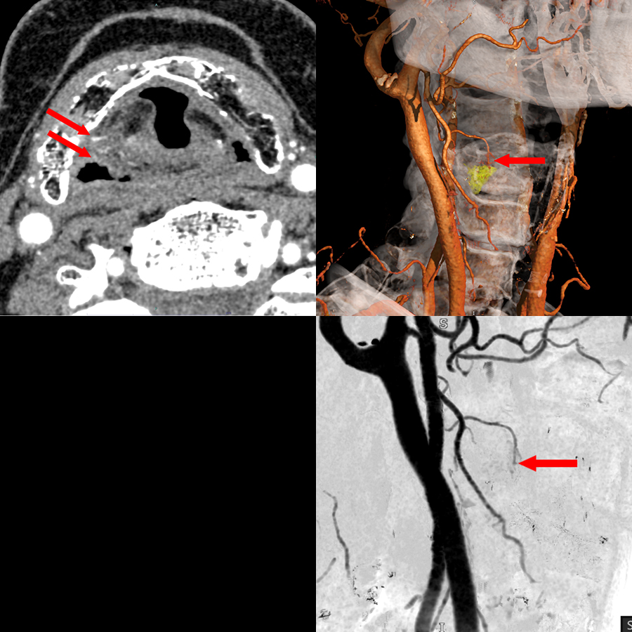 Headneck Cancer de la tête et du cou 1