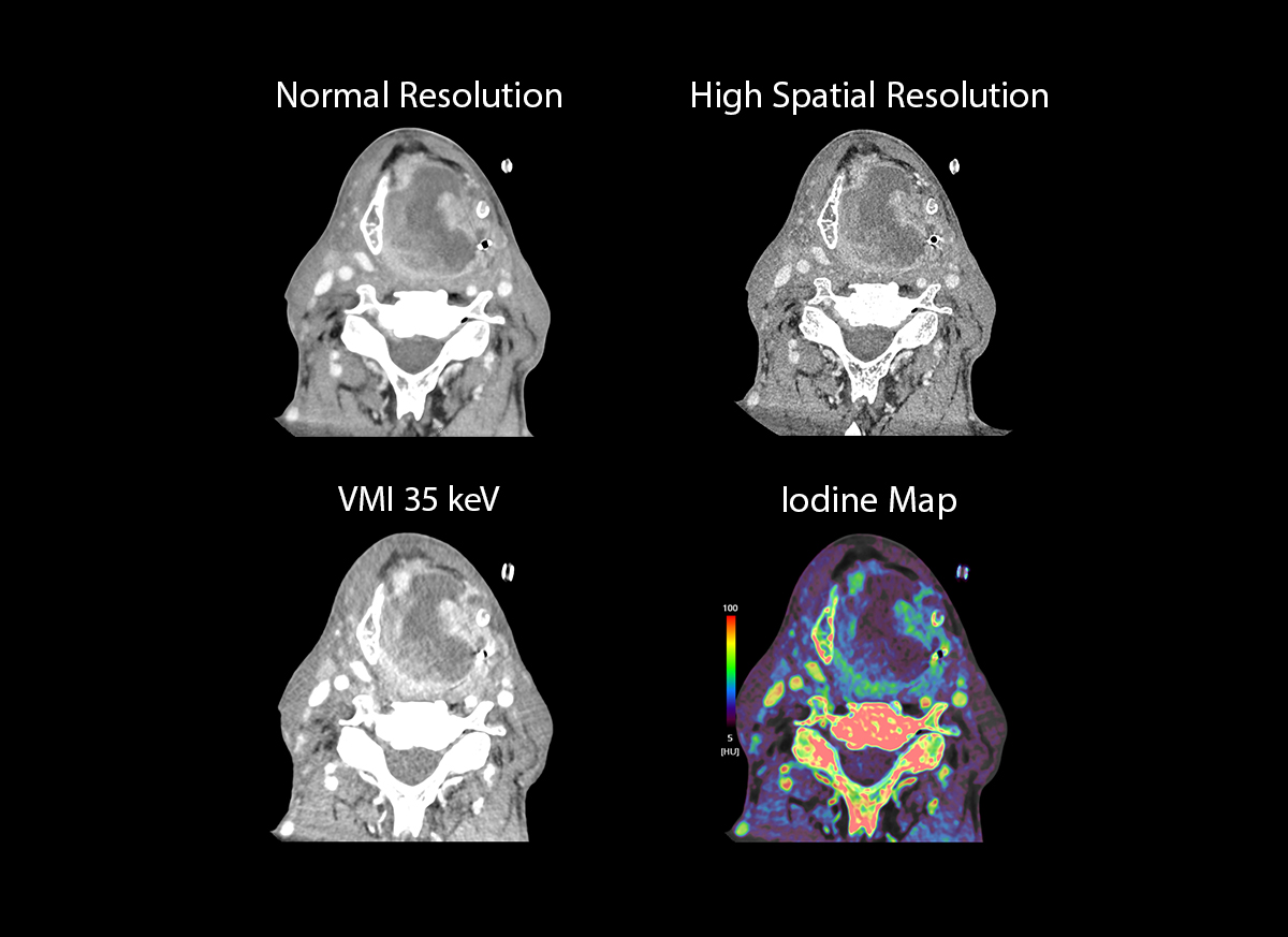 Pharyngeal Cancer