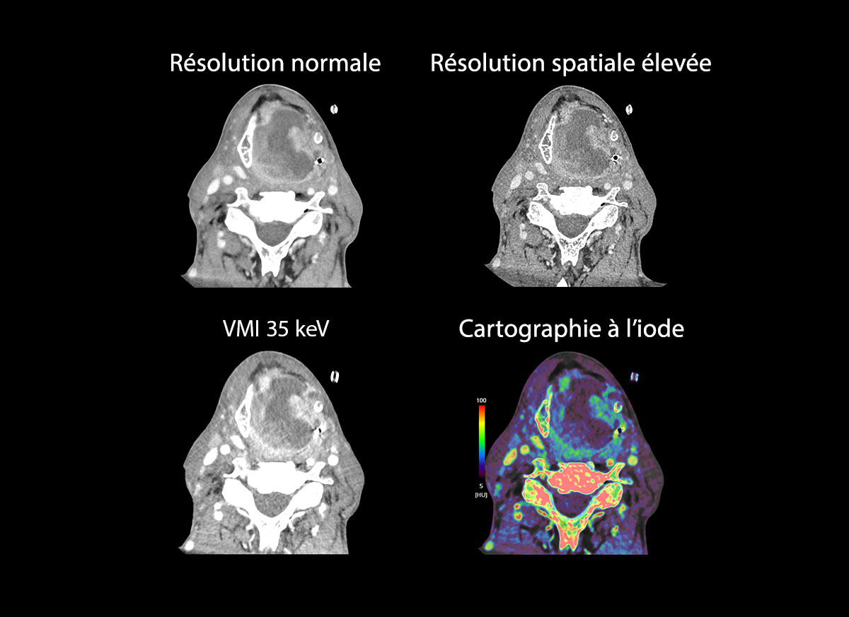 Headneck Cancer de la tête et du cou 2