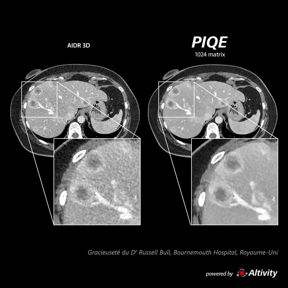 Piqe Cg Abdomen Abdomen en phase veineuse